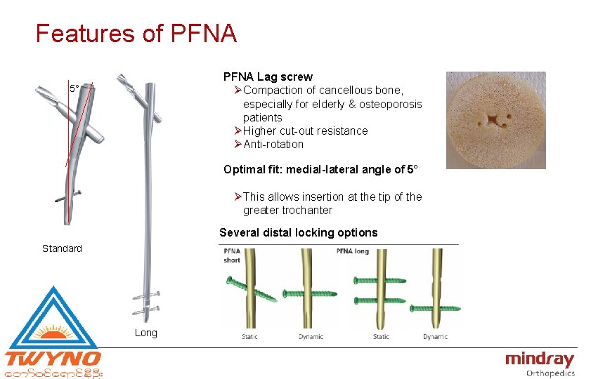 Features of PFNA Lag screw Ø Compaction of cancellous bone, especially for elderly &