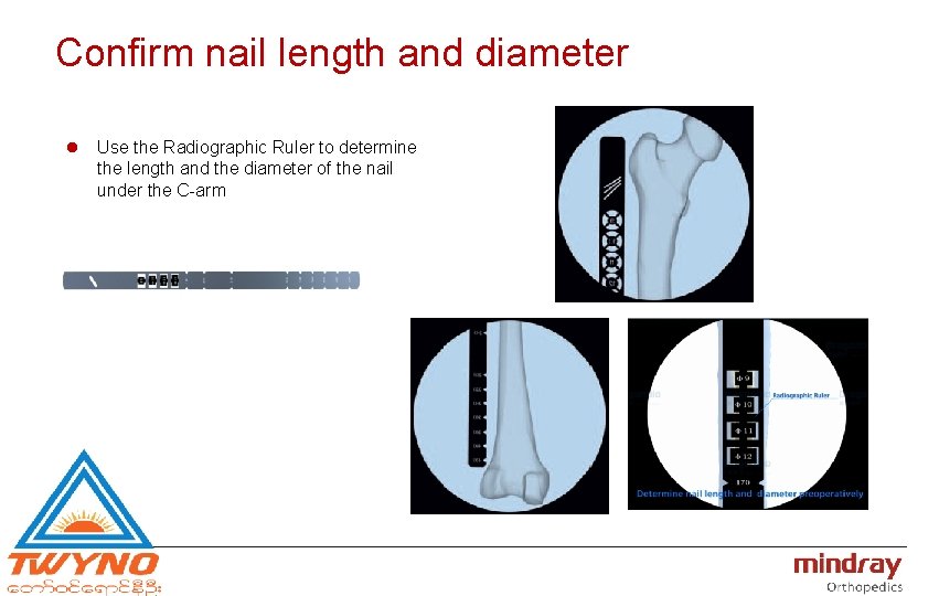 Confirm nail length and diameter l Use the Radiographic Ruler to determine the length