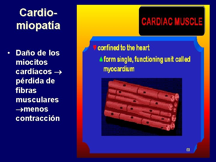 Cardiomiopatía • Daño de los miocitos cardíacos pérdida de fibras musculares menos contracción 