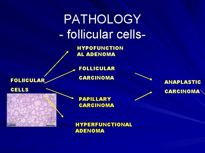 PATHOLOGY - follicular cells. HYPOFUNCTION AL ADENOMA FOLLICULAR FOLl. ICULAR CARCINOMA CELLS ANAPLASTIC CARCINOMA