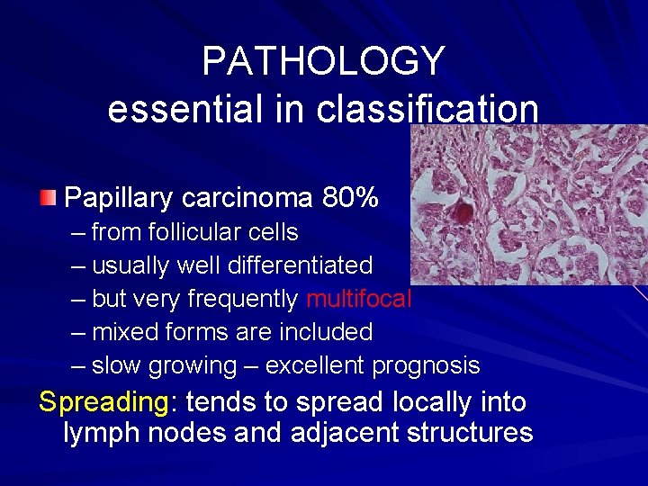 PATHOLOGY essential in classification Papillary carcinoma 80% – from follicular cells – usually well