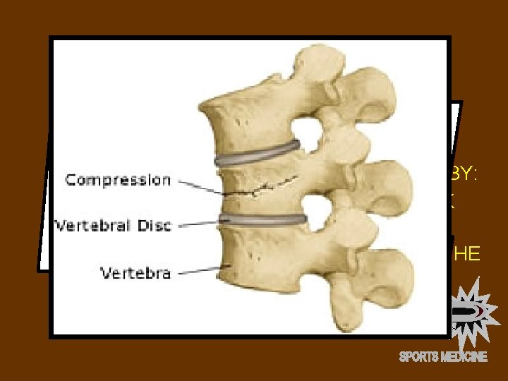 VERTEBRAL FRACTURE • FRACTURES OF THE VERTEBRAL SPINE ARE RARE. • WHEN THEY DO