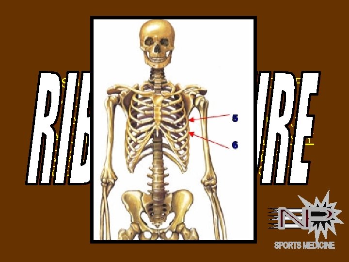 RIB FRACTURE • USUALLY A POSTERIOR RIB FRACTURE • OCCURS FROM A DIRECT BLOW.