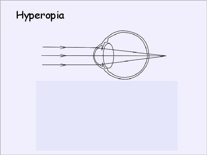 Hyperopia Convex lens for correction 