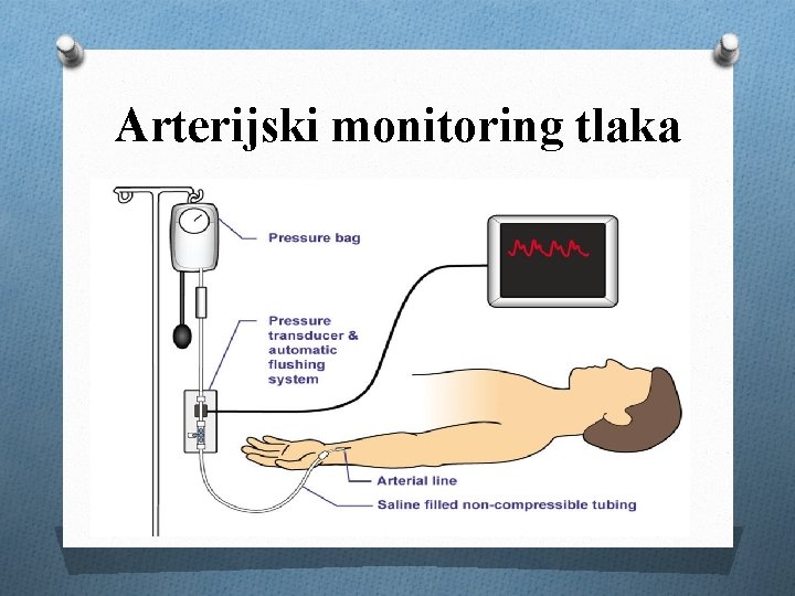 Arterijski monitoring tlaka 