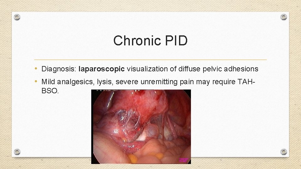 Chronic PID • Diagnosis: laparoscopic visualization of diffuse pelvic adhesions • Mild analgesics, lysis,