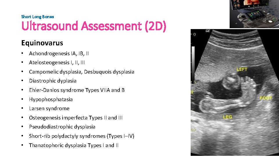 Short Long Bones Ultrasound Assessment (2 D) Equinovarus • Achondrogenesis IA, IB, II •