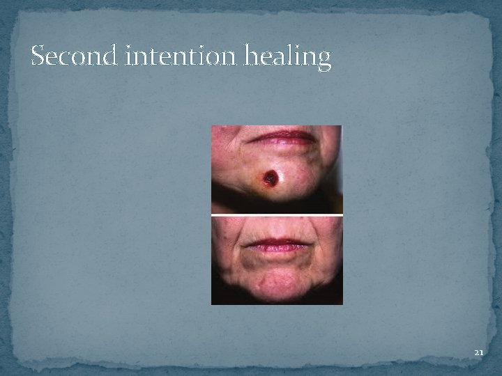 Second intention healing 21 Second intention healing 21