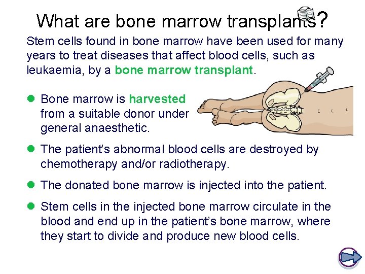 What are bone marrow transplants? Stem cells found in bone marrow have been used