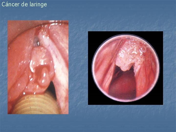 Cáncer de laringe 