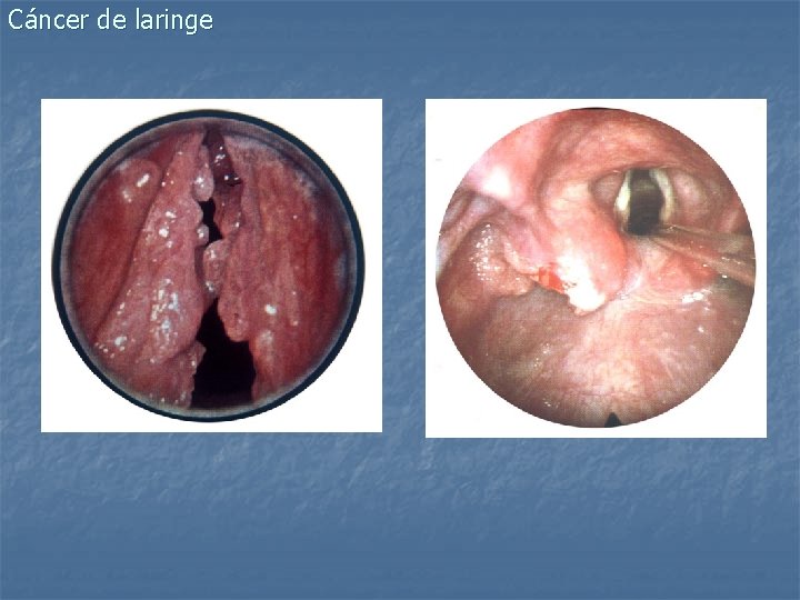 Cáncer de laringe 