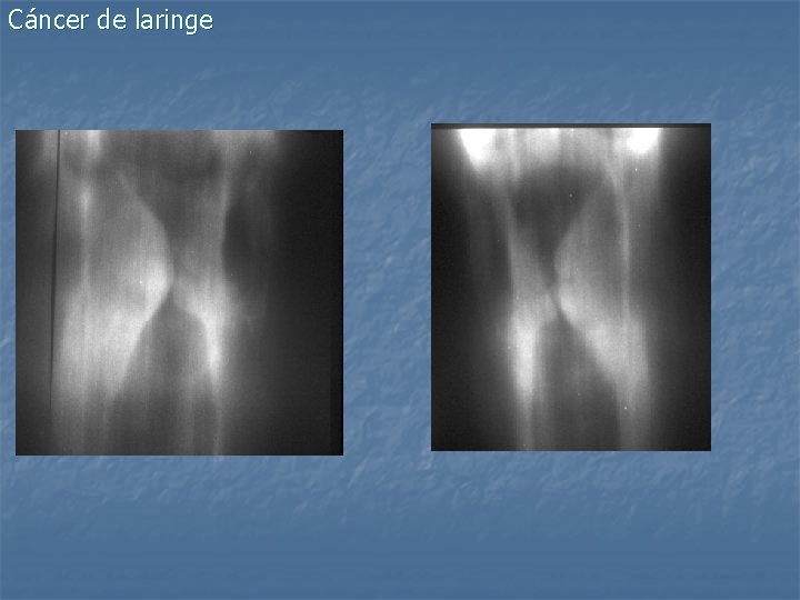 Cáncer de laringe 