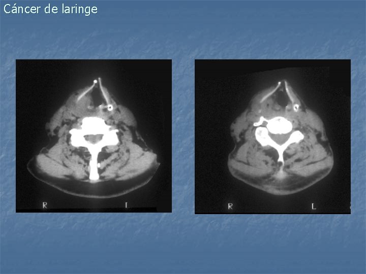 Cáncer de laringe 
