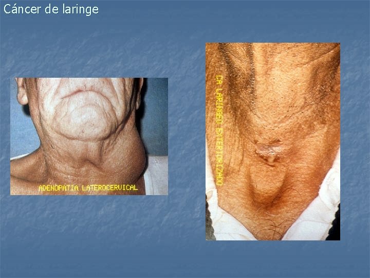 Cáncer de laringe 