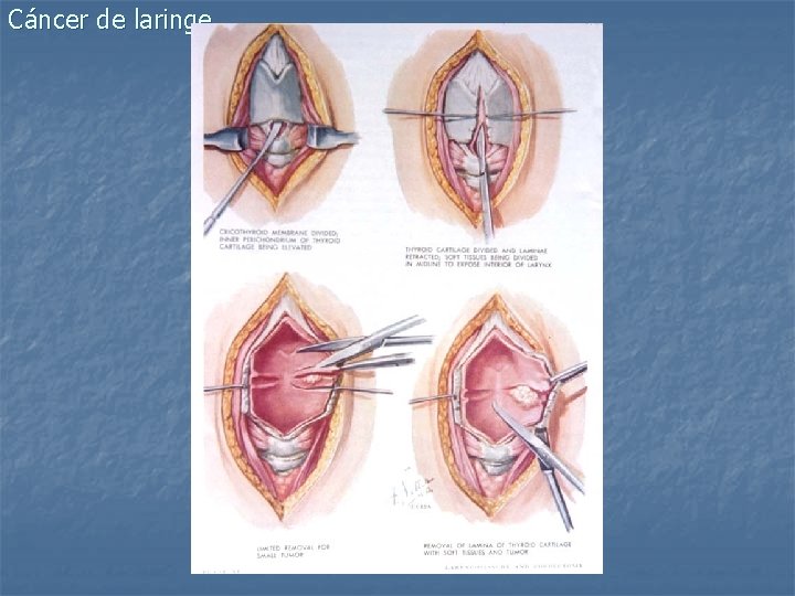 Cáncer de laringe 