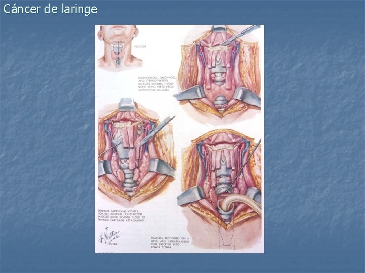 Cáncer de laringe 