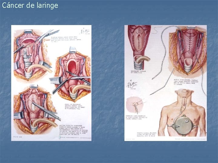 Cáncer de laringe 