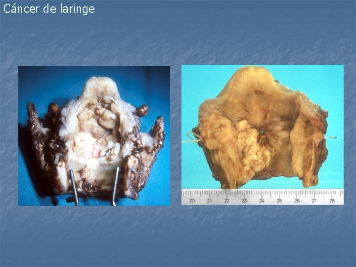 Cáncer de laringe 
