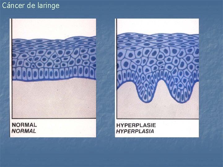 Cáncer de laringe 