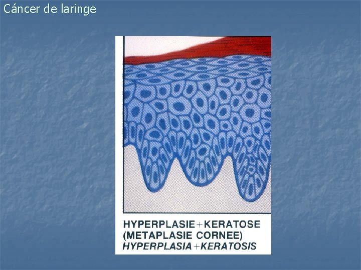 Cáncer de laringe 