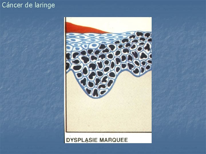 Cáncer de laringe 