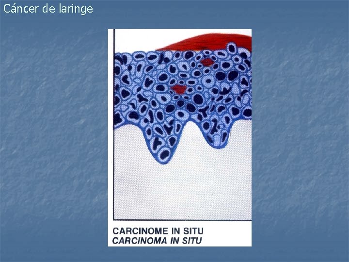 Cáncer de laringe 