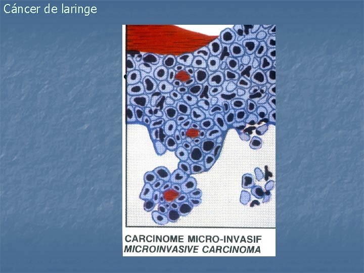 Cáncer de laringe 