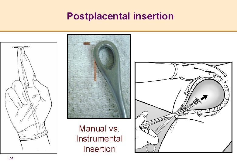 Postplacental insertion Manual vs. Instrumental Insertion 24 