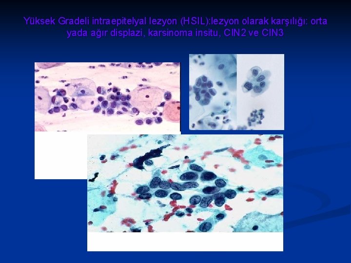 Yüksek Gradeli intraepitelyal lezyon (HSIL): lezyon olarak karşılığı: orta yada ağır displazi, karsinoma insitu,