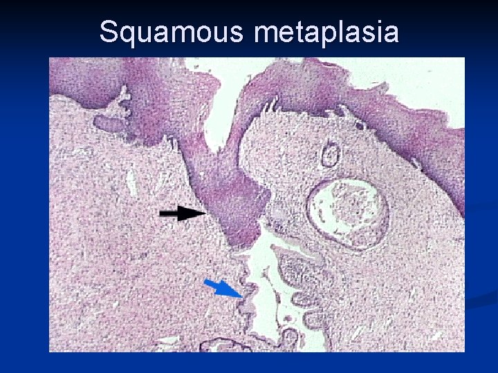 Squamous metaplasia 