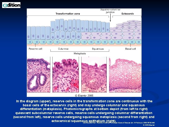 In the diagram (upper), reserve cells in the transformation zone are continuous with the
