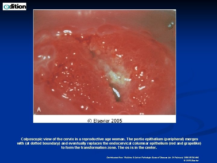 Colposcopic view of the cervix in a reproductive age woman. The portio epithelium (peripheral)