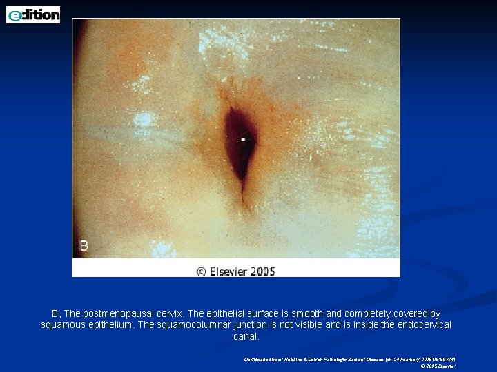 B, The postmenopausal cervix. The epithelial surface is smooth and completely covered by squamous