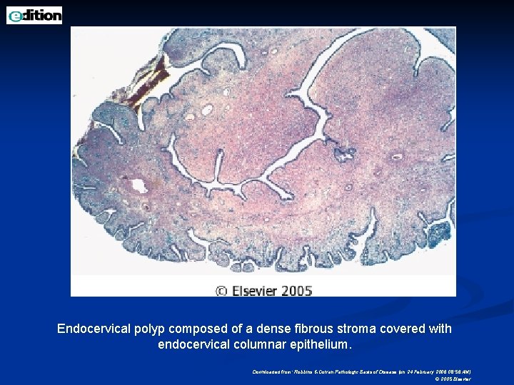 Endocervical polyp composed of a dense fibrous stroma covered with endocervical columnar epithelium. Downloaded
