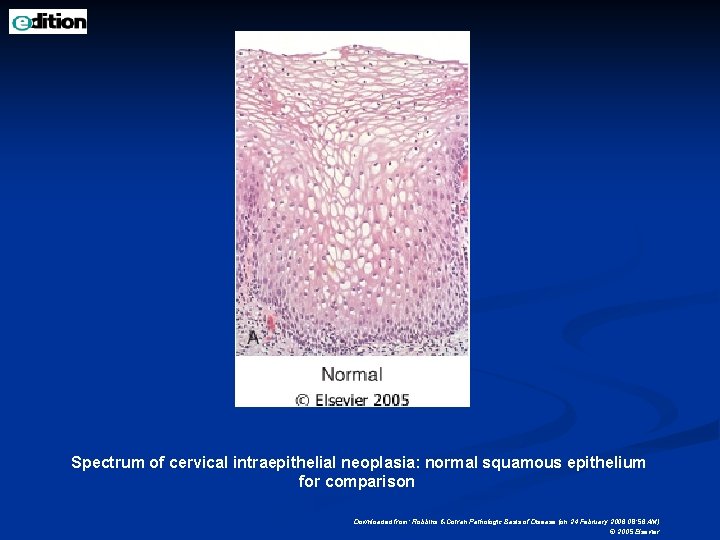 Spectrum of cervical intraepithelial neoplasia: normal squamous epithelium for comparison Downloaded from: Robbins &