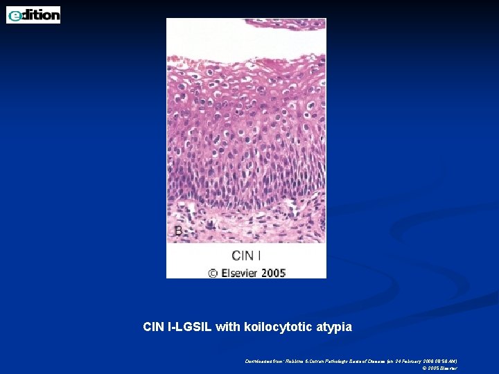 CIN I-LGSIL with koilocytotic atypia Downloaded from: Robbins & Cotran Pathologic Basis of Disease