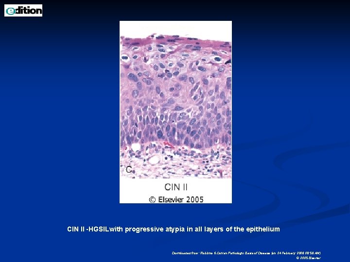 CIN II -HGSILwith progressive atypia in all layers of the epithelium Downloaded from: Robbins