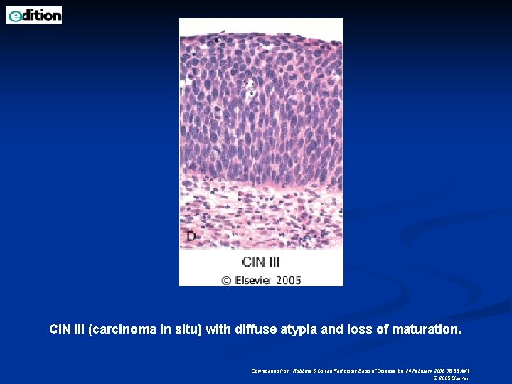 CIN III (carcinoma in situ) with diffuse atypia and loss of maturation. Downloaded from: