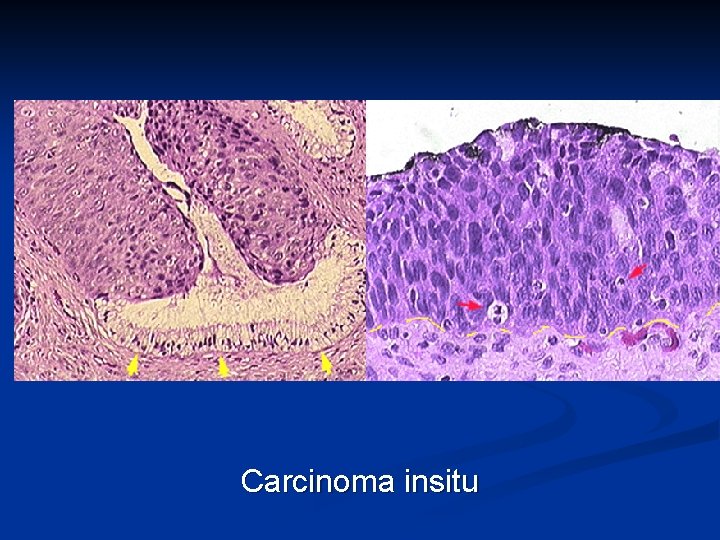 Carcinoma insitu 