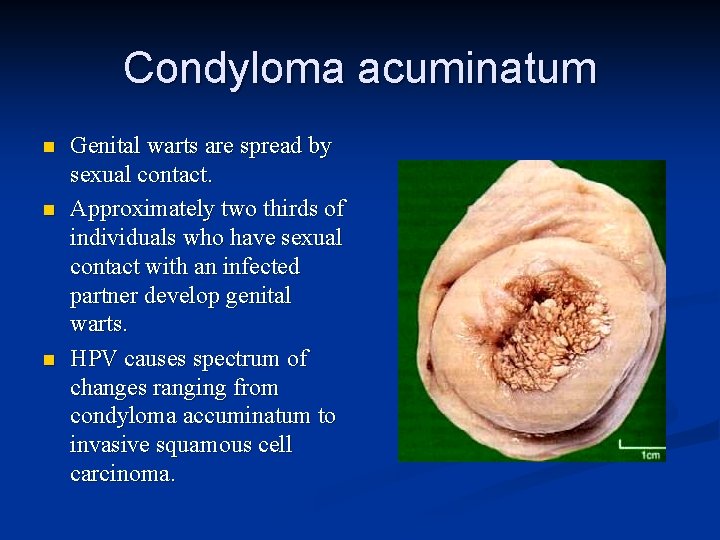 Condyloma acuminatum n n n Genital warts are spread by sexual contact. Approximately two