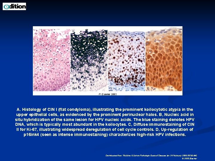 A. Histology of CIN I (flat condyloma), illustrating the prominent koilocytotic atypia in the