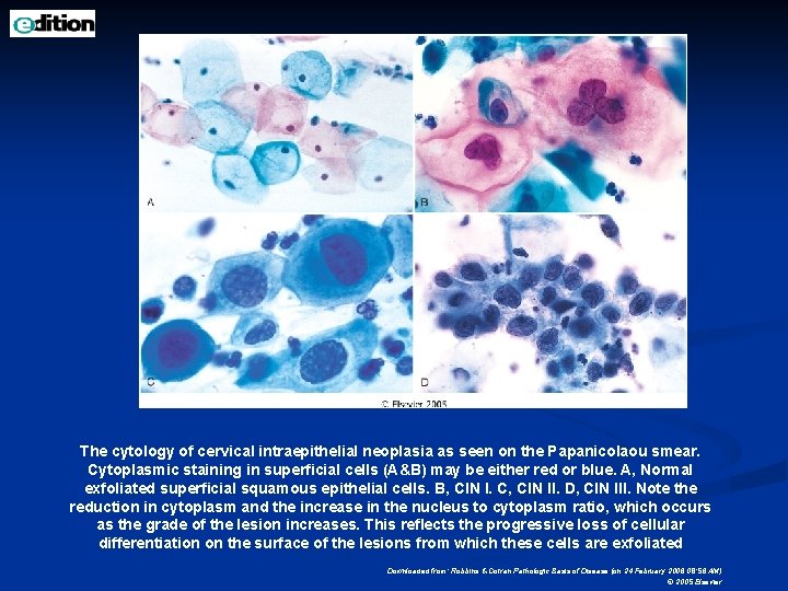 The cytology of cervical intraepithelial neoplasia as seen on the Papanicolaou smear. Cytoplasmic staining
