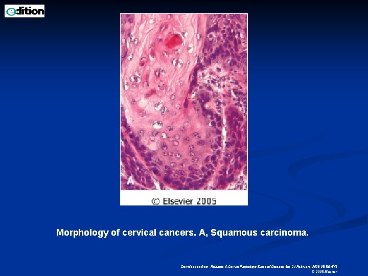 Morphology of cervical cancers. A, Squamous carcinoma. Downloaded from: Robbins & Cotran Pathologic Basis