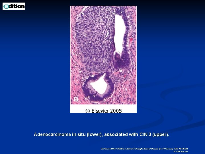 Adenocarcinoma in situ (lower), associated with CIN 3 (upper). Downloaded from: Robbins & Cotran