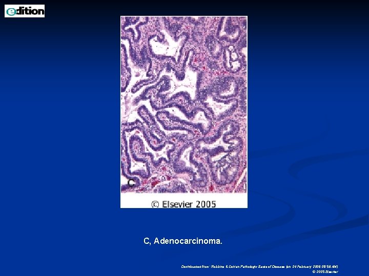 C, Adenocarcinoma. Downloaded from: Robbins & Cotran Pathologic Basis of Disease (on 24 February