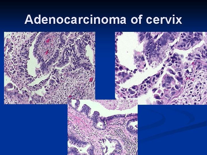 Adenocarcinoma of cervix 