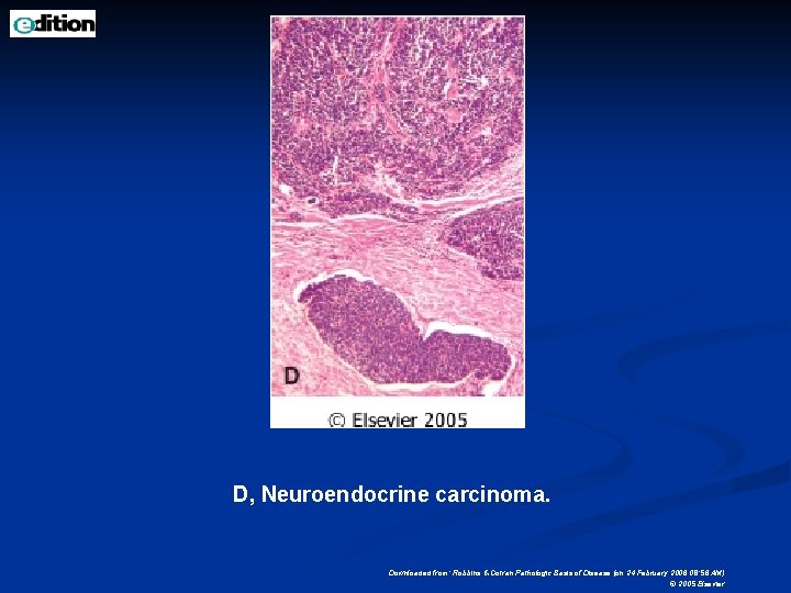 D, Neuroendocrine carcinoma. Downloaded from: Robbins & Cotran Pathologic Basis of Disease (on 24