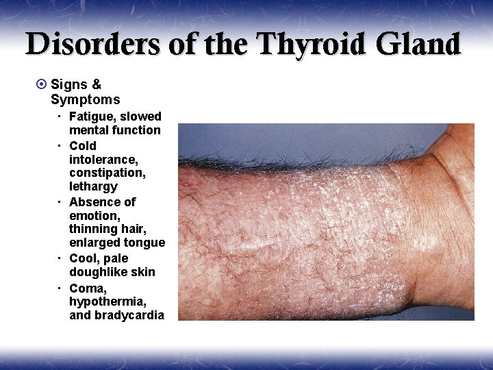 Disorders of the Thyroid Gland ¤ Signs & Symptoms Fatigue, slowed mental function Cold