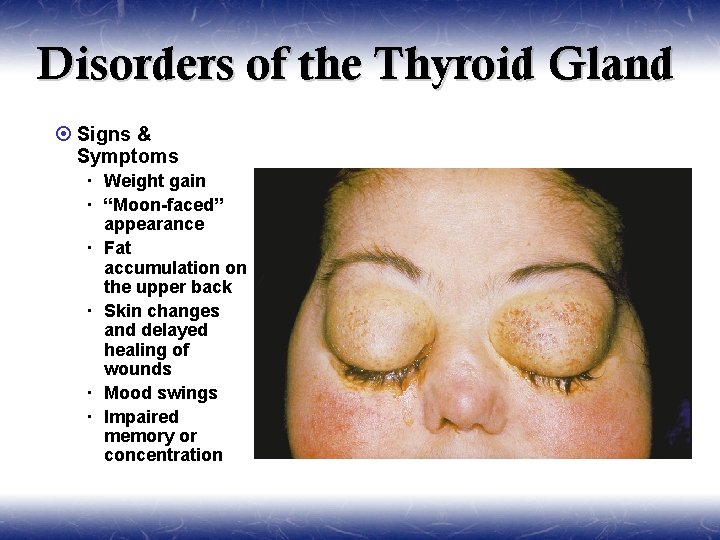 Disorders of the Thyroid Gland ¤ Signs & Symptoms Weight gain “Moon-faced” appearance Fat