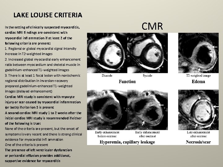 LAKE LOUISE CRITERIA In the setting of clinically suspected myocarditis, cardiac MRI fi ndings